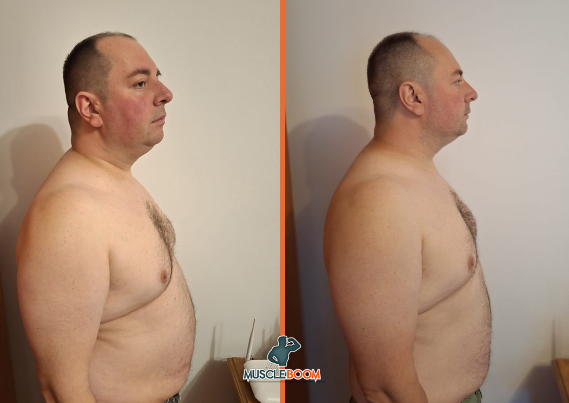 Radu-before-after-13weeks-lateral